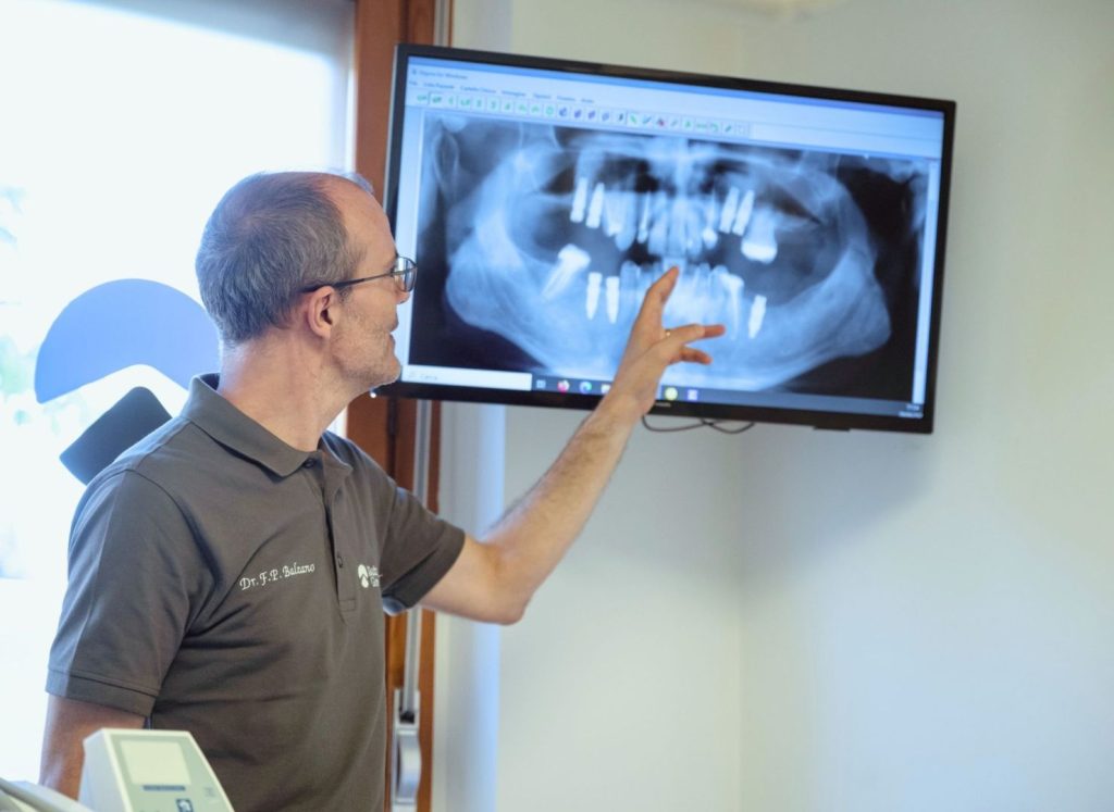 Come funziona un impianto dentale? 1 come funziona un impianto dentale